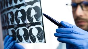 A person in blue nitrile gloves holds a printed sheet of chest CT scan images showing cross-sections of the lungs and points to it with a pen, with a bearded man in glasses blurred in the background. | Image Credit: © Markoff - stock.adobe.com