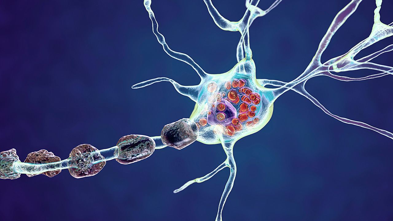 Brain neurons in lysosomal storage diseases, 3D illustration | Image credit: © Dr_Microbe - © Dr_Microbe - stock.adobe.com