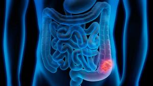 Darmpolyp | Image credit: © peterschreiber.media - © peterschreiber.media - stock.adobe.com
