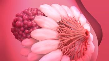 3D cross-section illustration of breast tissue showing pink lobes, milk ducts converging toward the nipple, and a dark red clustered mass representing a tumor. | Image Credit: © Design cells - stock.adobe.com
