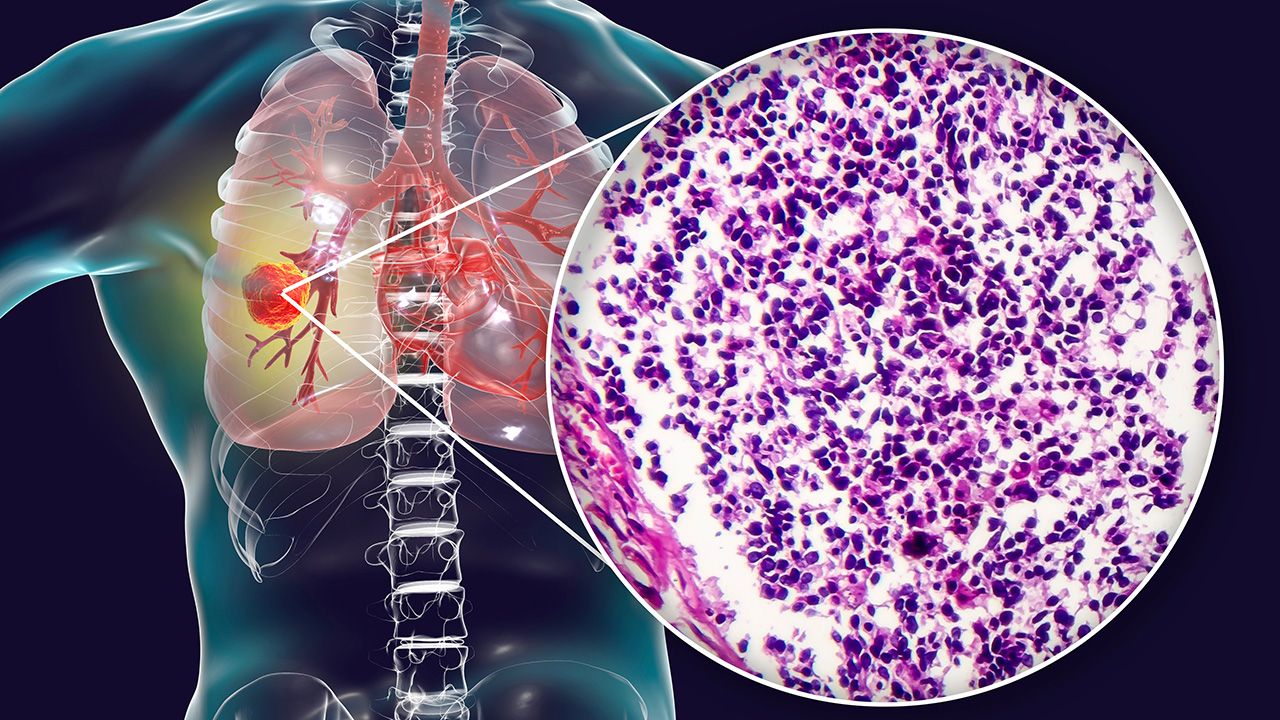 Lung cancer, 3D illustration and photo under microscope. Histopathology light micrograph of small cell lung cancer | Image Credit: © Dr_Microbe - © Dr_Microbe - stock.adobe.com