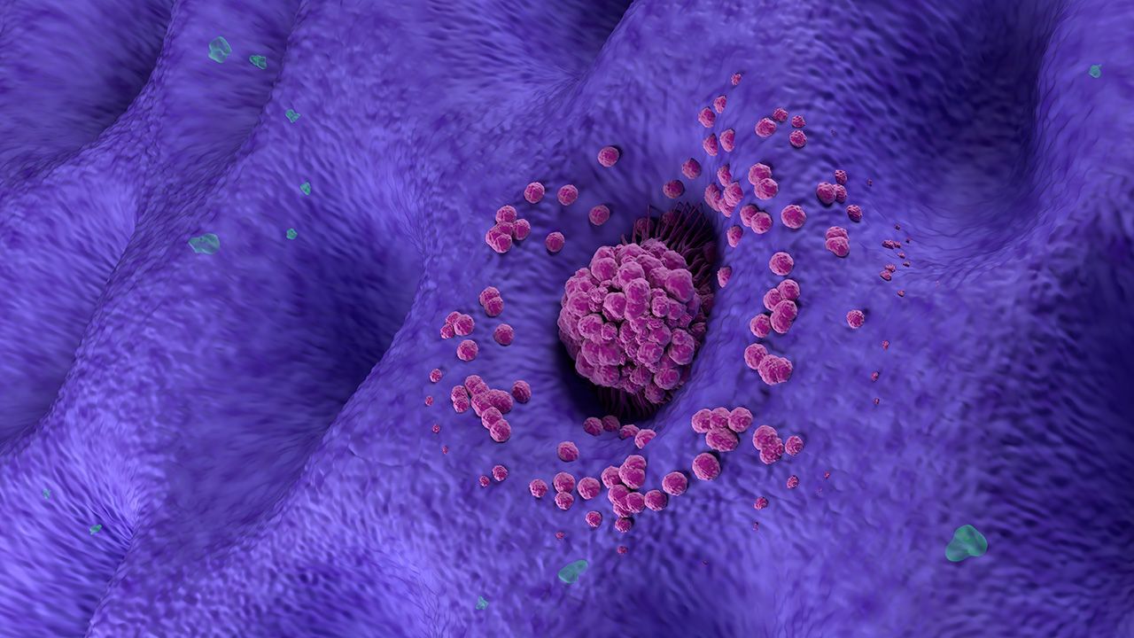 Early stage gastric cancer tumor on the stomach wall angle view 3d illustration | Image credit: © LASZLO - © LASZLO - stock.adobe.com