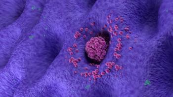Early stage gastric cancer tumor on the stomach wall angle view 3d illustration | Image credit: © LASZLO - © LASZLO - stock.adobe.com