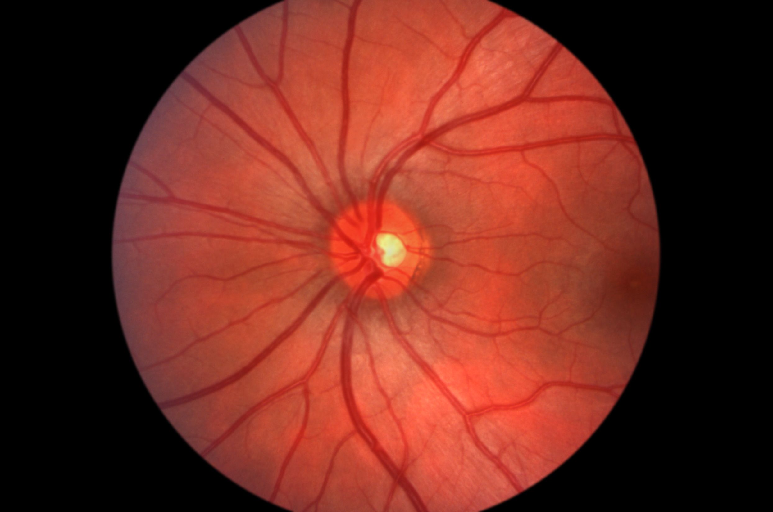 Retinal imaging photograph showing the human retina and optic nerve. | Image Credit: © LightScribe - stock.adobe.com