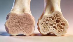 Denosumab Biosimilar KN012 Matches Reference Drug in Phase 3 Osteoporosis Trial