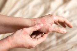 Omalizumab Biosimilar Matches Reference Product in Chronic Spontaneous Urticaria