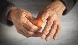 Biosimilar Tocilizumab Cost-Effective for Treatment of Rheumatoid Arthritis in Spain