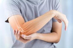 Two More Pairs of Denosumab Biosimilars Enter US Market