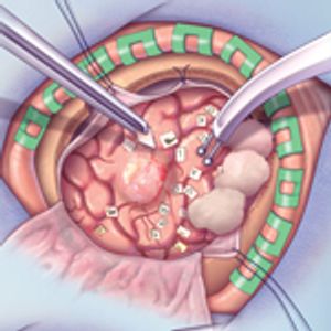Newer Strategies for the Management of Low-Grade Gliomas