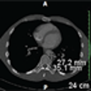 Nonseminomatous Germ Cell Tumor of Testis and Interrupted Treatment