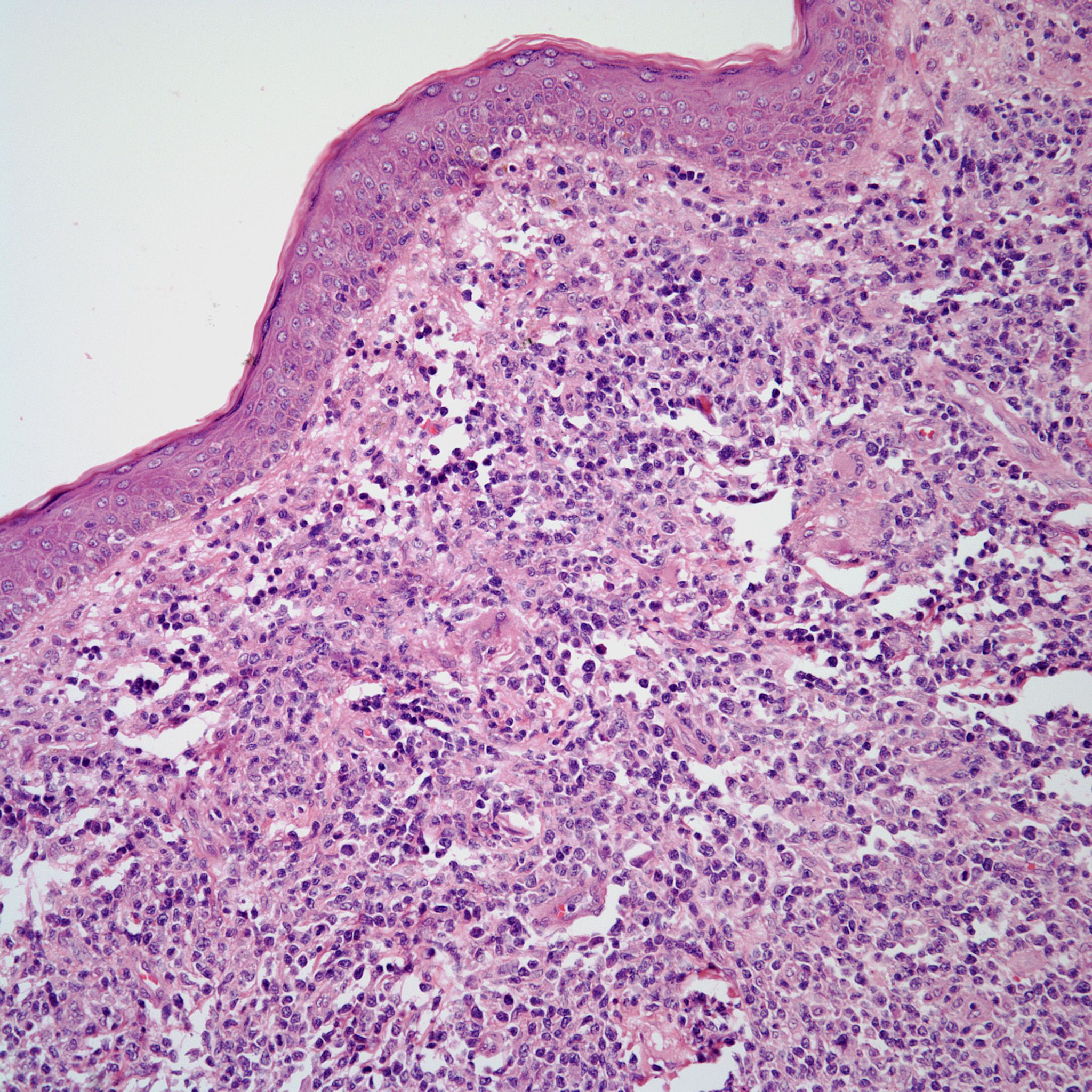 A 57-Year-Old Man With History of Pruritic Rashes | CancerNetwork