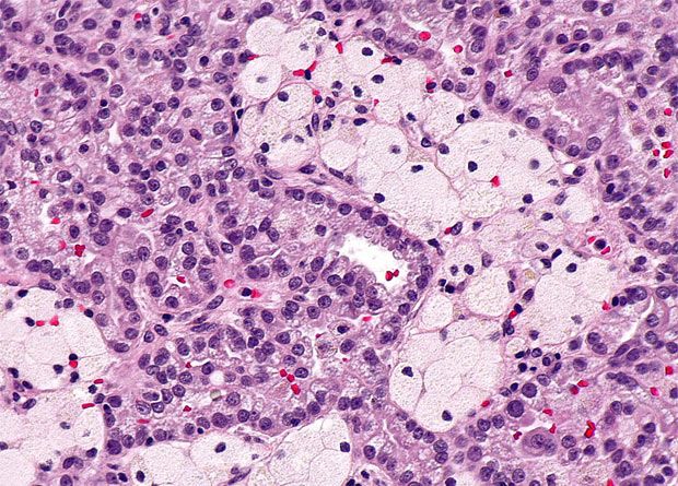 Slide Show: Renal Cell Carcinoma