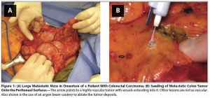 Gastrointestinal Cancers With Peritoneal Carcinomatosis: Surgery and Hyperthermic Intraperitoneal Chemotherapy