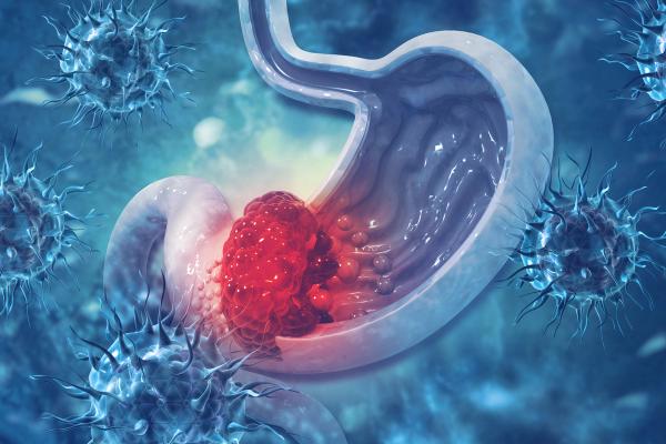 Givastomig Earns FDA Fast Track Designation in HER2-Negative Gastric Cancer