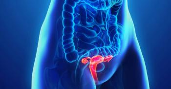 T-Cell Clonal Expansion Achieved by Adding Atezolizumab to Chemoradiation for Locally Advanced Cervical Cancer