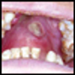 Current Management of Nasal NK/T-cell Lymphoma