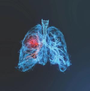 EGFR ex 20+ NSCLC After Platinum Chemotherapy Responds to Mobocertinib Monotherapy