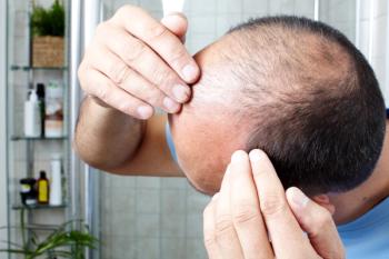 alopecia