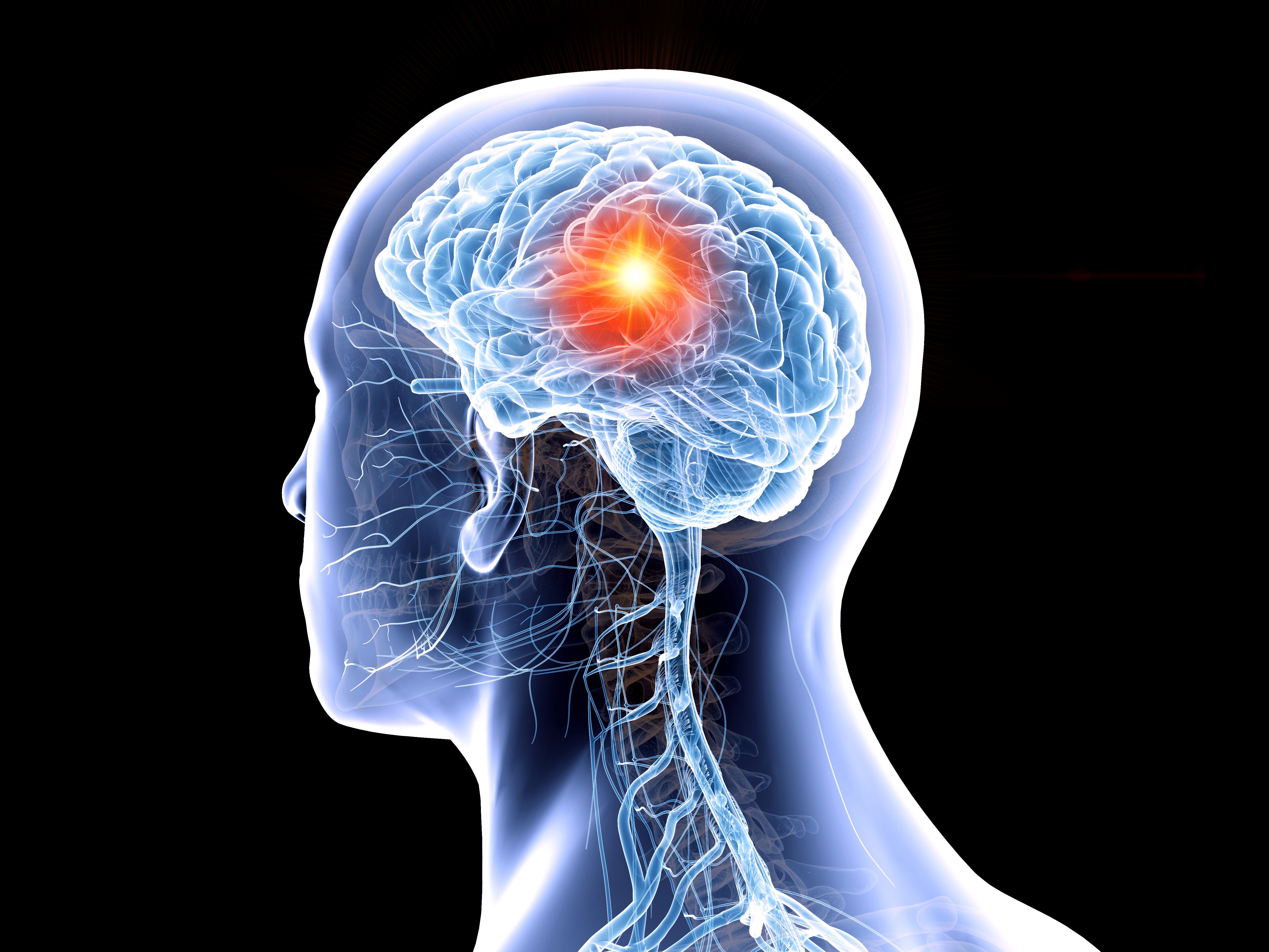 Tile-Based Radiation Improves Surgical Bed Recurrence in Brain Metastases: © Sebastian Kaulitzki - stock.adobe.com