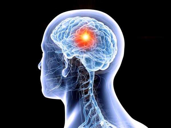 Tile-Based Radiation Improves Surgical Bed Recurrence in Brain Metastases: © Sebastian Kaulitzki - stock.adobe.com