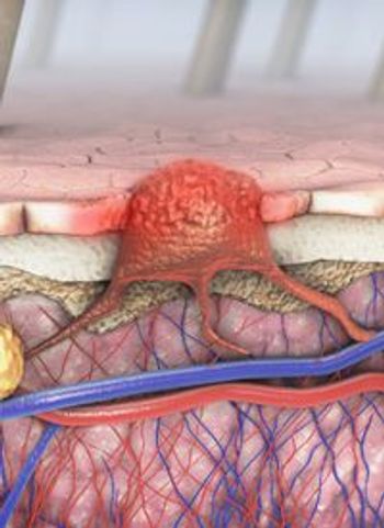 Experts analyze the evolving landscape of melanoma treatment, highlighting key clinical trials and strategies for optimizing patient outcomes.