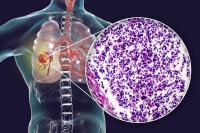 CRS onset typically occurred within 12 hours after tarlatamab infusion and was resolved with antipyretics for fever and intravenous fluids.