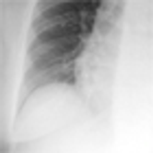 A 63-Year-Old Patient Presents With Significant Dyspnea