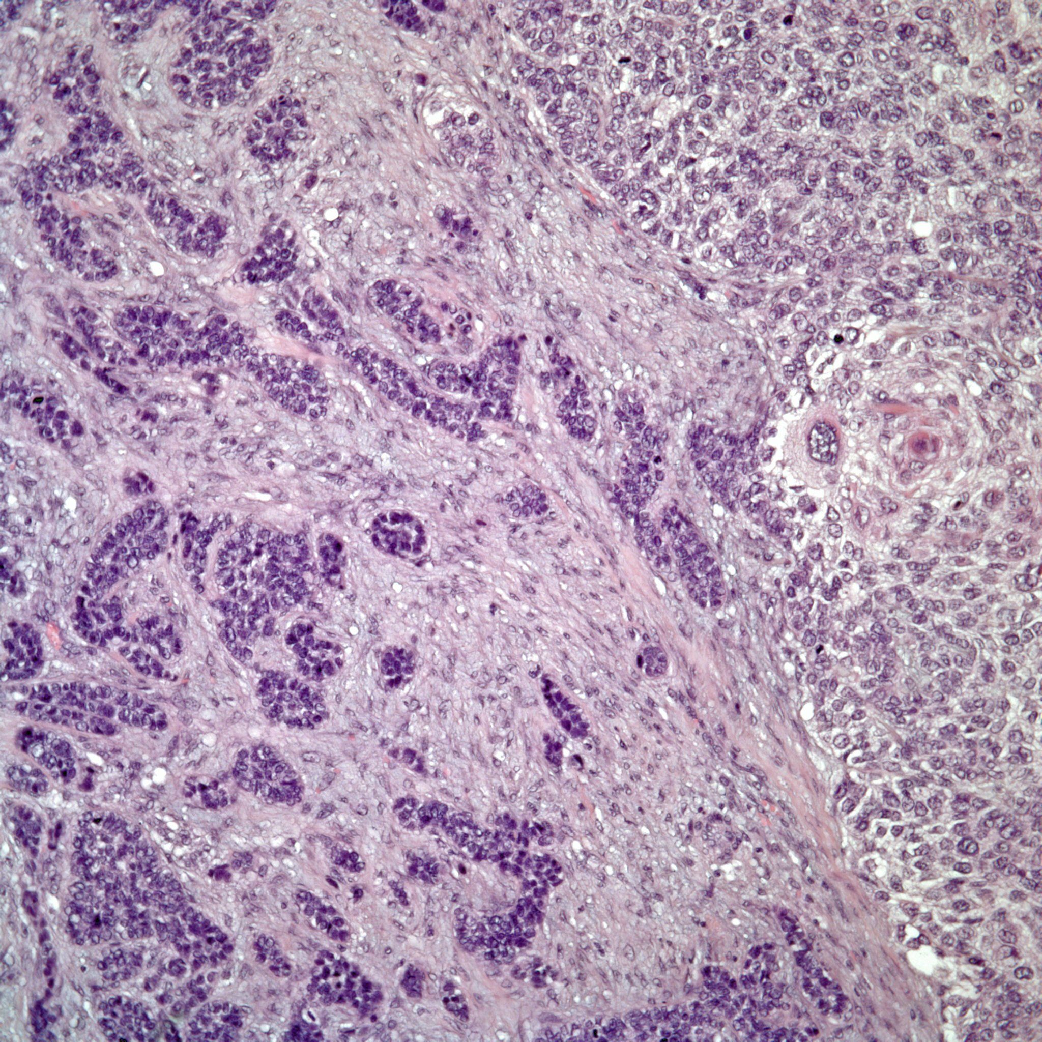 a-56-year-old-man-with-an-intranasal-mass