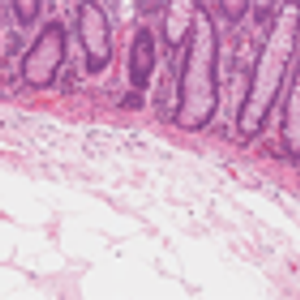Neoplasm Lacking the Usual Genetic Markers Associated With Colorectal Neoplasms