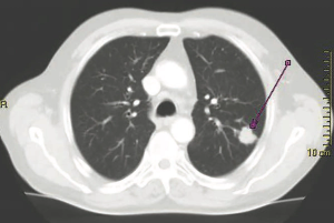 2019 World Conference Of Lung Cancer Round-Up