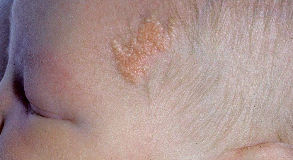 Neonate With a Soft, YellowishColored Plaque on the Temple