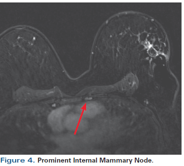 A 55 Year Old Woman With New Triple Negative Breast Mass Less Than 2 Cm On Both Mammogram And Ultrasound