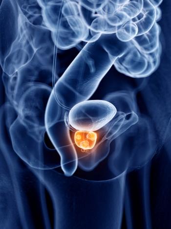 The phase 3 MIRAGE trial findings show that PROSTOX ultra was validated as a biomarker to predict genitourinary toxicity following SBRT.