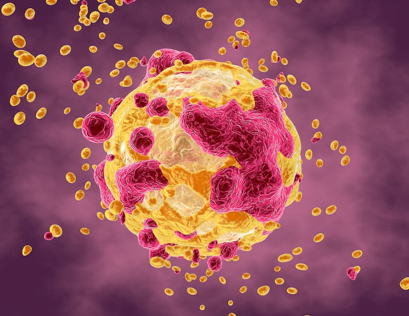Data Show Elevated Risk of Thoracic Soft Tissue Sarcomas After Radiotherapy Treatment for Breast Cancer