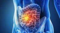 STELLAR-303 Regimen Misses End Point in CRC Population: © 姣姣 - stock.adobe.com