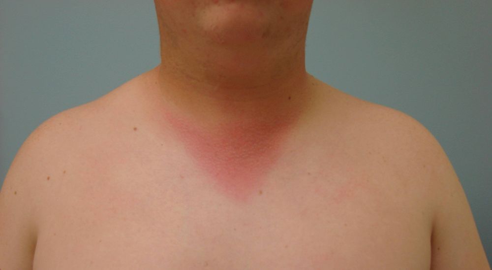 A 67-Year-Old Male Cancer Patient Presents With a Painful Erythema