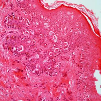 Pembrolizumab plus platinum-containing therapy may be a new treatment option for advanced penile cancer based on data from the HERCULES trial.
