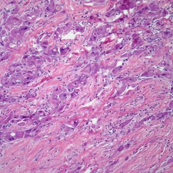 Durvalumab plus bevacizumab and TACE may be a new standard of care in unresectable hepatocellular carcinoma eligible for embolization, according to Riccardo Lencioni, MD.