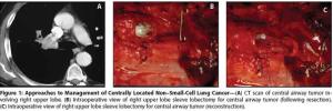 Management of Centrally Located Non-Small-Cell Carcinoma