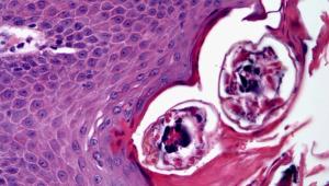 Skin Lesions on a 12-Year-Old Patient