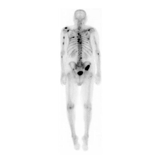 Bone scan showing osseous metastases from prostate cancer