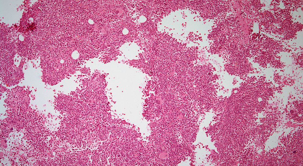 Investigators are evaluating IO-202 in patients with newly diagnosed chronic myelomonocytic leukemia as part of a phase 1 dose expansion trial.