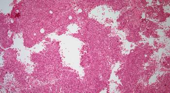 Investigators are evaluating IO-202 in patients with newly diagnosed chronic myelomonocytic leukemia as part of a phase 1 dose expansion trial.