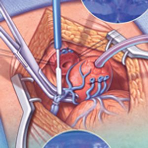 Radical Prostatectomy for Patients With Oligometastatic Prostate Cancer