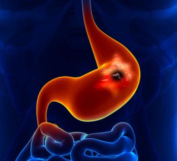 gastric cancer