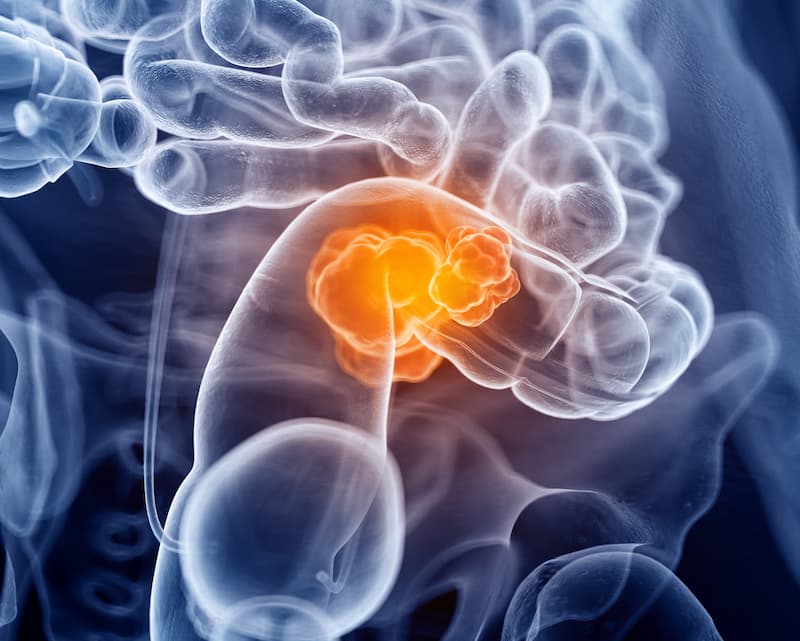 Takayuki Yoshino, MD, PhD, Illuminates Research Supporting Panitumumab Over Bevacizumab Plus mFOLFOX6 for Metastatic CRC