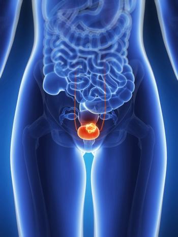 Complete response rates were observed consistently across patient subgroups in those with high-risk BCG-unresponsive non-muscle invasive bladder cancer.