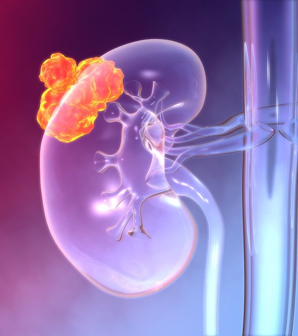 Modulation of angiogenic and immune-related pathways in ccRCC might provide rationale for checkpoint- or VEGFR-TKI–based combinations with HC-7366.