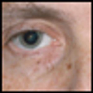 Supraclavicular Extraskeletal Myxoid Chondrosarcoma Presenting With a Sensorimotor Polyneuropathy Associated  With Anti-Hu Antibodies