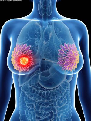 Clinical Trials in Breast and Endometrial Cancer